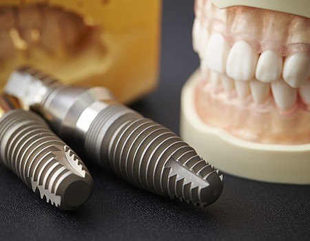 Smile and dental implant models