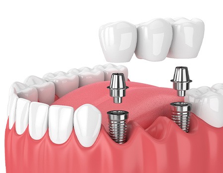 Illustration of implant bridge
