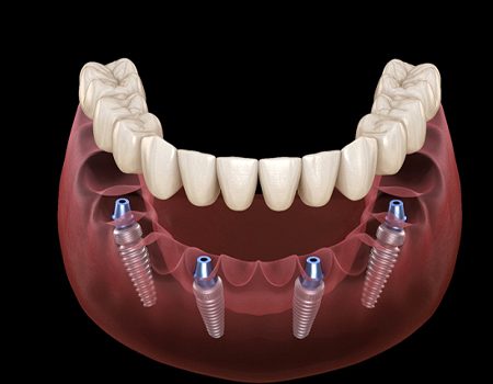 Model of All-On-4 lower denture.