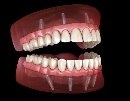 Digital model of teeth-in-a-day