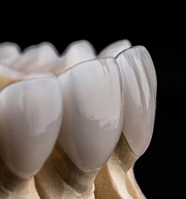 A dental bridge on a model jaw