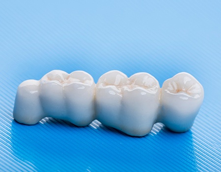 A traditional dental bridge