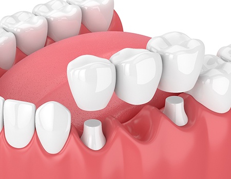 a computer-generated image of a dental bridge