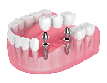 A dental implant bridge