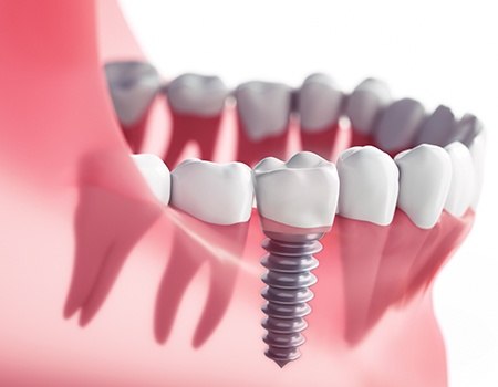 Animation of implant supported dental crown