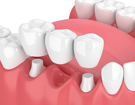 Animation of implant fixed bridge placement