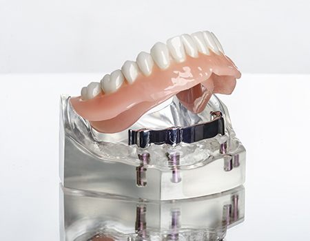 Model of implant supported denture