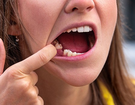 Woman with a missing tooth