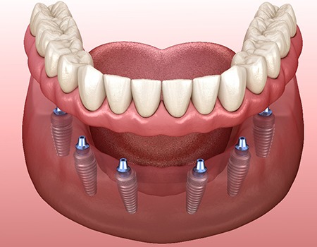 A 3D illustration of implant dentures