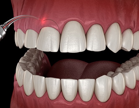 a computer design showing how gum recontouring works with a dental laser