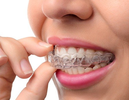 Woman placing Invisalign tray