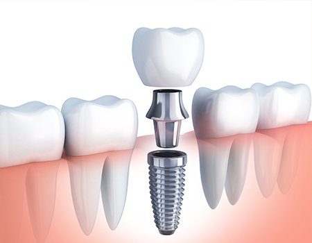 Animation of dental implant supported crown placement