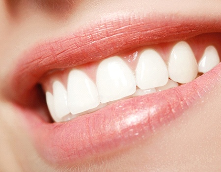 woman with veneers