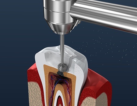 Animation of root canal process