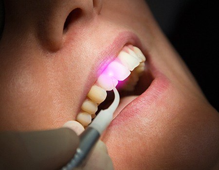 Closeup of patient receiving soft tissue laser dentistry