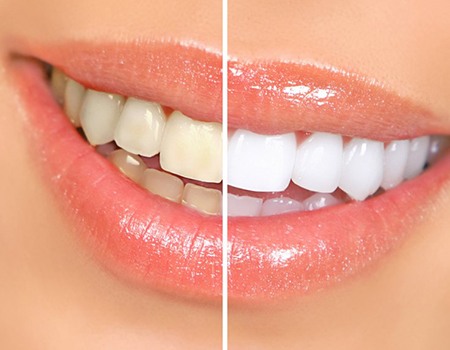 Before and after teeth whitening