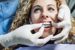 dentist with patient and clear aligner