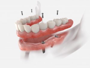 3D illustration implant dentures