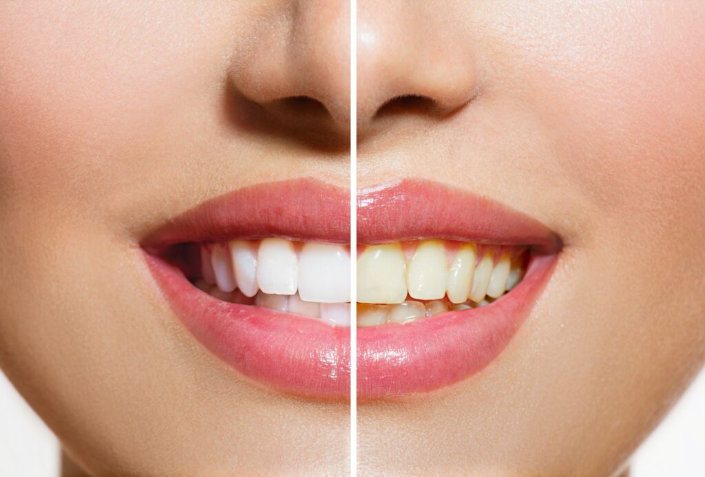 Nose-to-chin closeup of woman's smile that's half whitened to show before/after results