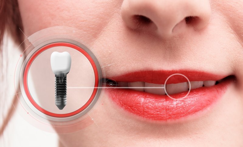 A photo highlighting a woman’s dental implant