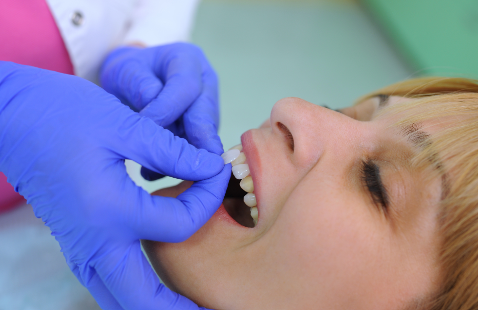 Woman getting veneer fitted