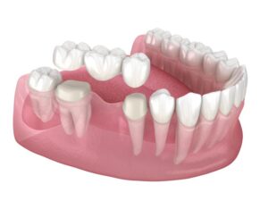 Animated rendering of dental bridge.