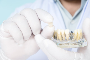 Dentist holding a dental implant crown and implant model